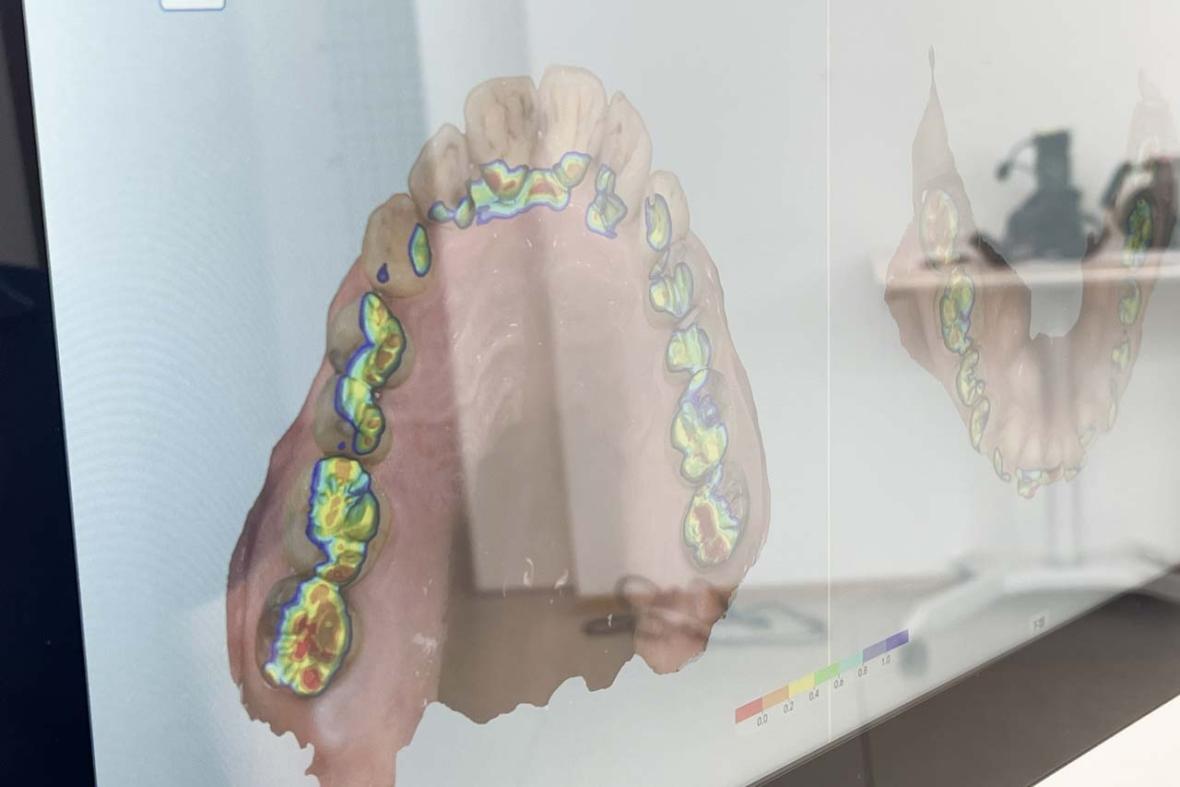 口腔スキャナー