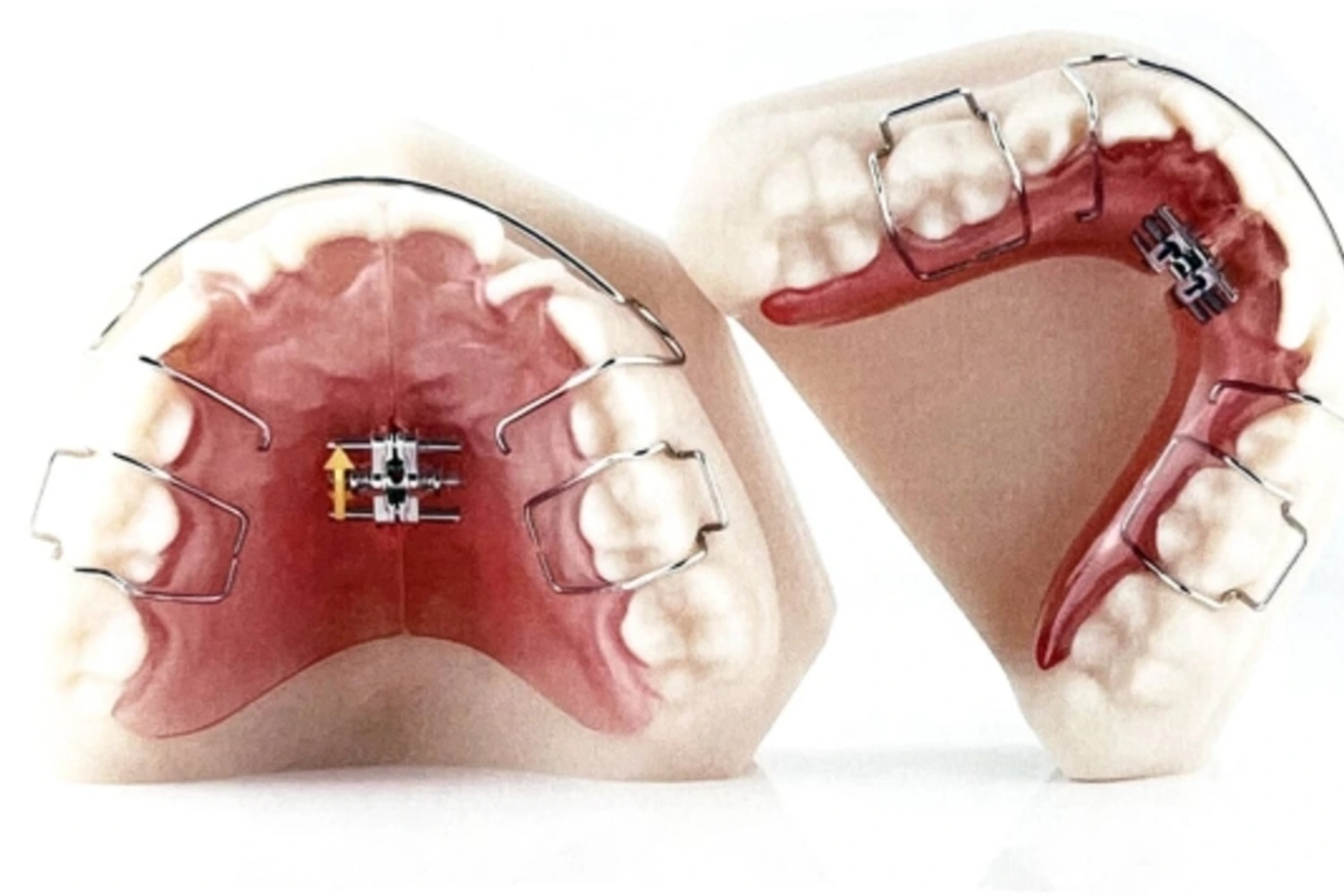 稲沢市のグランツ歯科室の床矯正の器具