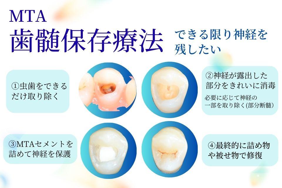 稲沢市グランツ歯科室の歯髄保存療法（MTA）説明図